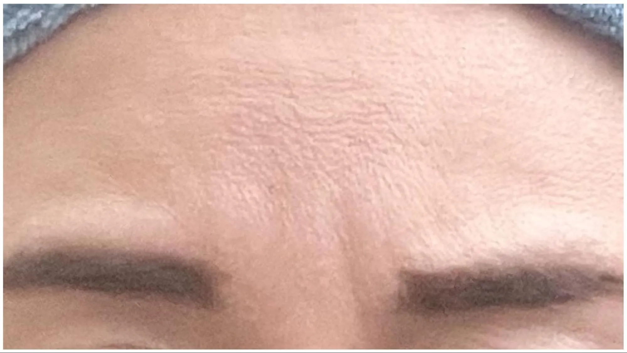 眉間の表情じわ