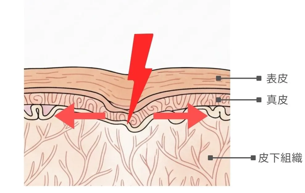 皮膚断面のイラスト